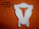 Thumbnail Gynefix - Einlage in der Frauenarztpraxis